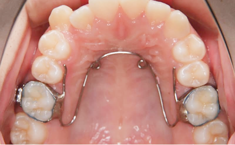 リンガルアーチ・クワドヘリックス