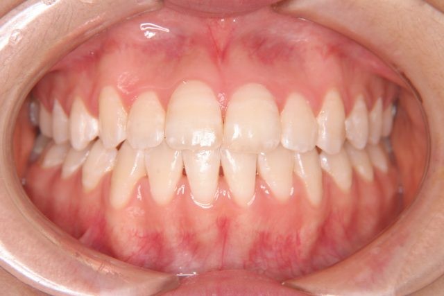 前歯のねじれが気になる