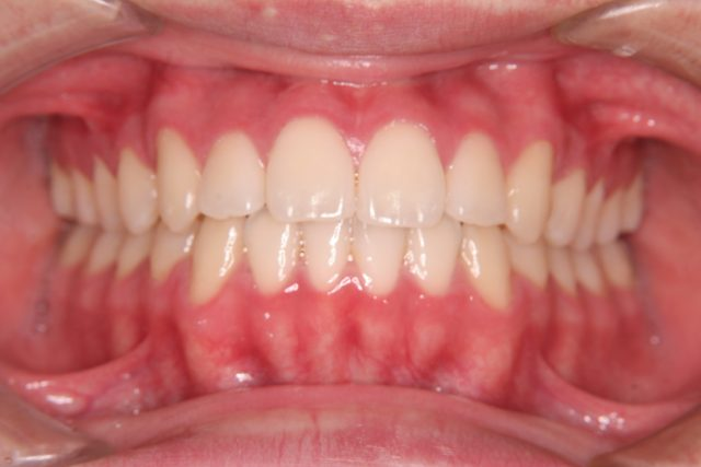 前歯の噛み合わせが気になる