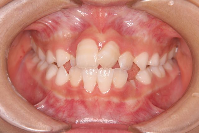 前歯のねじれが気になる